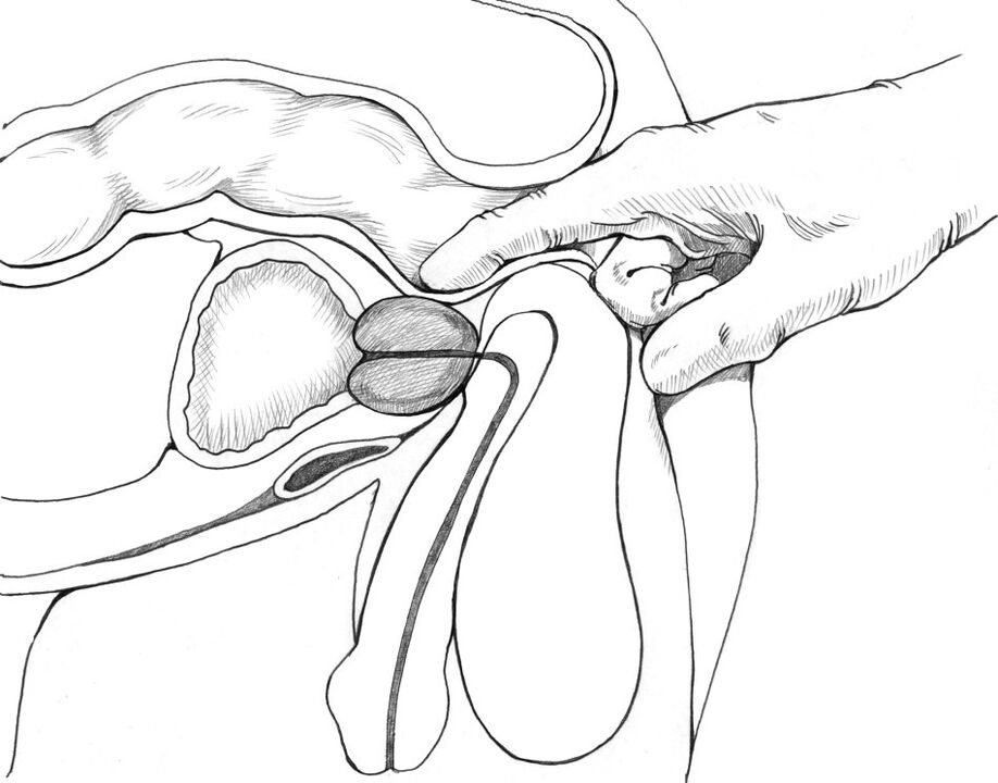 Masaža prostate je uključena u kompleks metoda liječenja prostatitisa