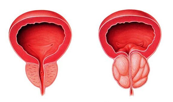 Normalna i upaljena prostata (prostatitis)